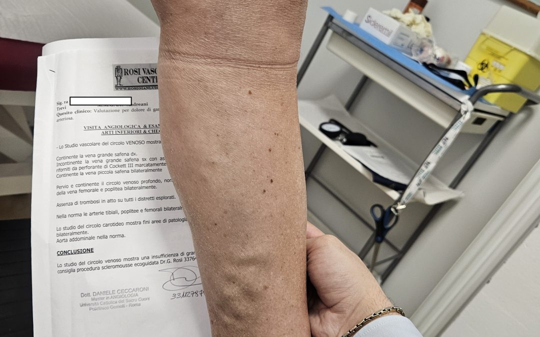 Cura della malattia venosa cronica invalidante