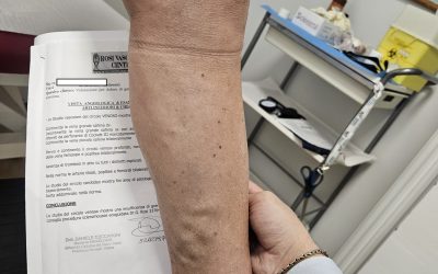 Cura della malattia venosa cronica invalidante