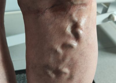 Scleroterapia Spoleto - Terni - Foligno